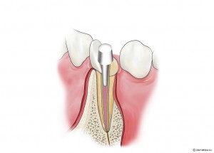 抜髄5　土台の装着
